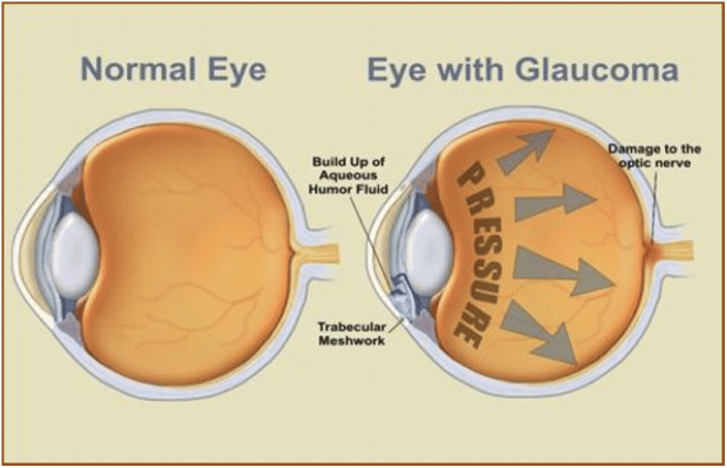 Understanding Glaucoma